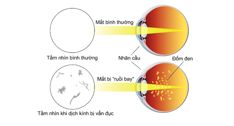 Ruồi bay trước mắt là hiện tượng nhìn thấy những đốm đen, sợi chỉ, hoặc hình dạng kỳ lạ trôi nổi trong tầm nhìn của mình. 