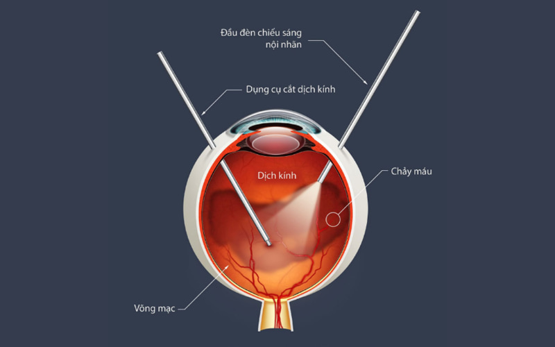 Phẫu thuật cắt dịch kính là một thủ thuật phẫu thuật mắt được thực hiện để loại bỏ dịch kính, một chất gel trong suốt lấp đầy khoang mắ