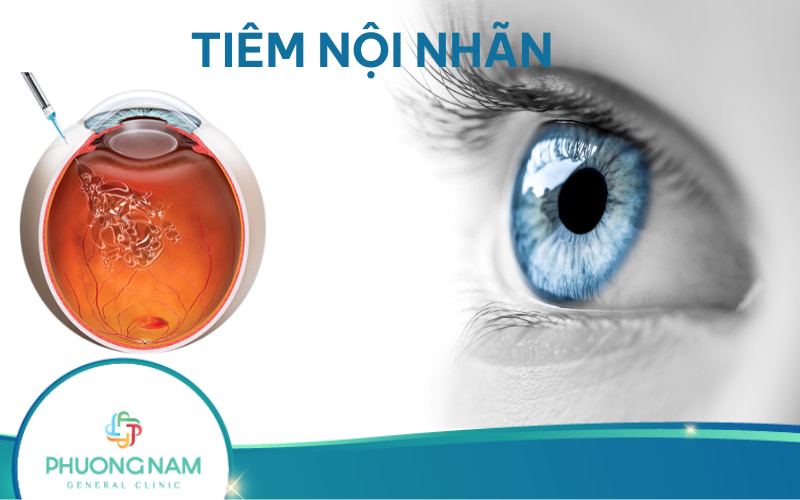 Tiêm nội nhãn là gì? Khi nào cần thực hiện thủ thuật?