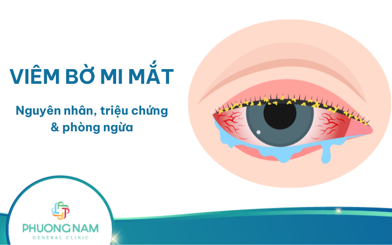 Viêm bờ mi mắt: triệu chứng, cách điều trị và phòng ngừa