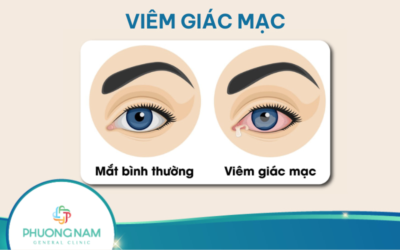 Viêm giác mạc: Nguyên nhân, triệu chứng, biện pháp phòng tránh