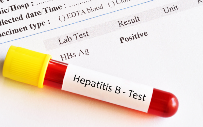 Xét nghiệm máu có thể phát hiện virus viêm gan B và chẩn đoán bệnh chính xác.
