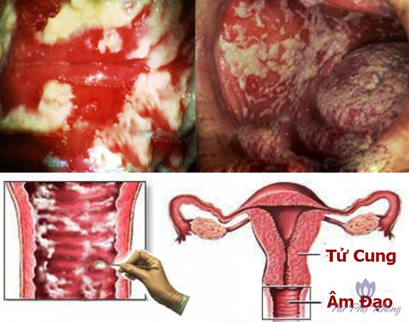 Viêm âm đạo ở phụ nữ