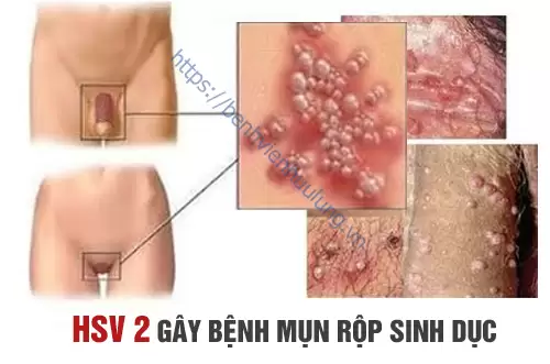 Mụn rộp sinh dục: Nguyên nhân, triệu chứng, biến chứng và cách điều trị hiệu quả