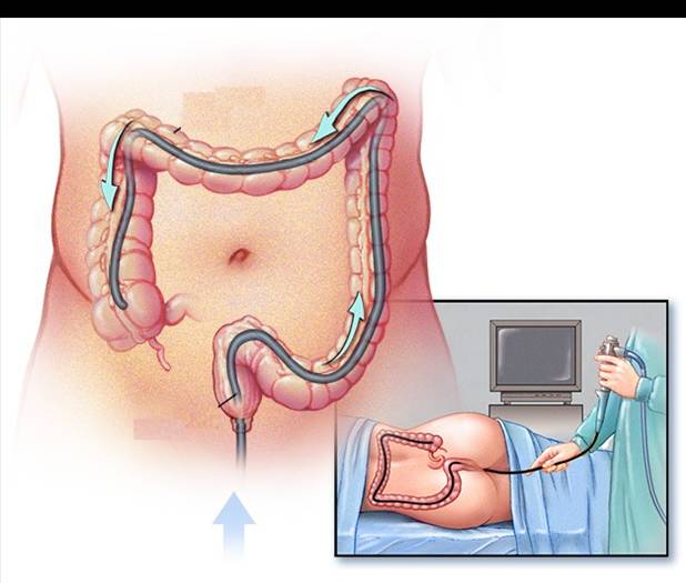 Nội soi đại tràng có đau không? Giải đáp từ chuyên gia