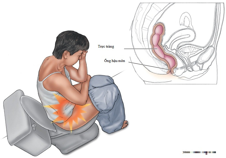 Đau Hậu Môn Kéo Dài: Nguyên Nhân, Triệu Chứng & Cách Điều Trị Hiệu Quả