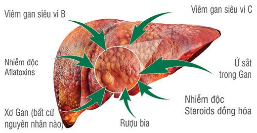 6 Yếu Tố Tăng Nguy Cơ Mắc Ung Thư Gan: Nguyên Nhân, Dấu Hiệu Và Cách Phòng Ngừa