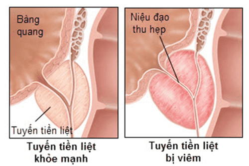 Viêm tuyến tiền liệt: Dấu hiệu nhận biết, nguyên nhân và phương pháp điều trị hiệu quả