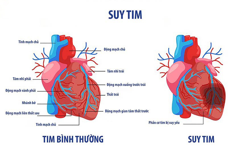 Suy Tim: Nguyên Nhân, Triệu Chứng và Cách Điều Trị Hiệu Quả